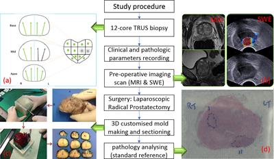 Prostate Cancer Gleason Score From Biopsy to Radical Surgery: Can Ultrasound Shear Wave Elastography and Multiparametric Magnetic Resonance Imaging Narrow the Gap?